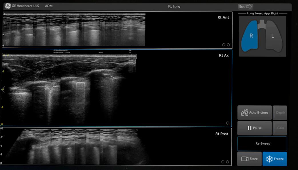 Obraz ultrasonograficzny uzyskany za pomocą narzędzia Lung Sweep