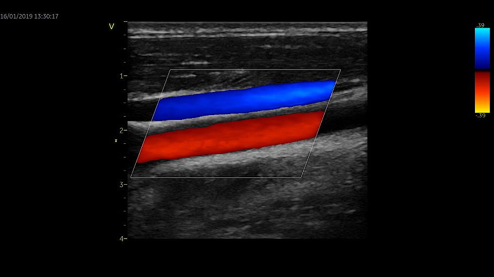 Klinický snímek ultrazvukového vyšetření cév