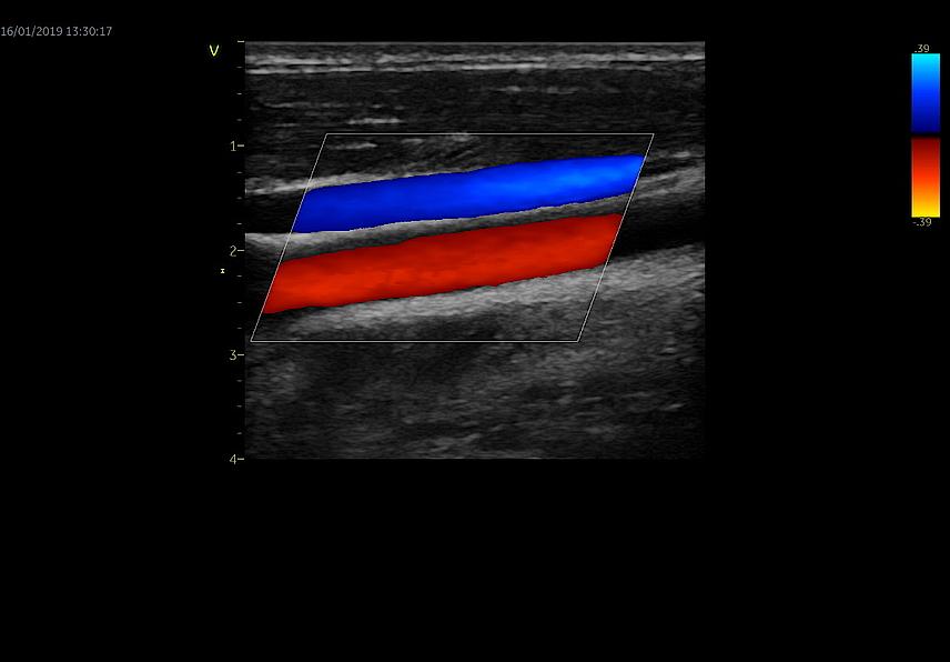 Klinický snímek z ultrazvukového cévního vyšetření