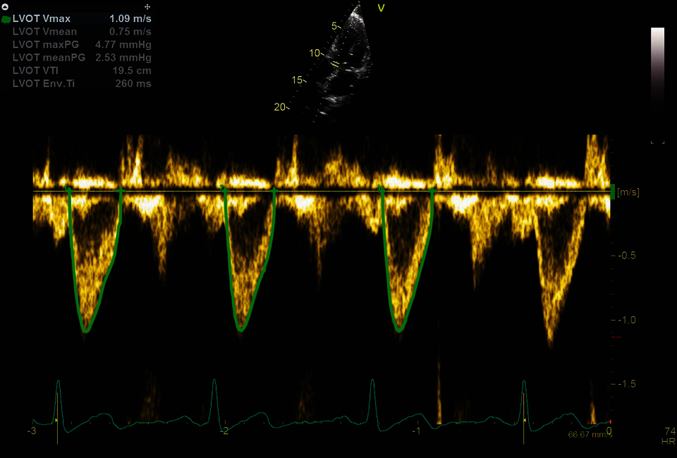 Az AI Cardiac Auto Dopplerrel rögzített klinikai kép
