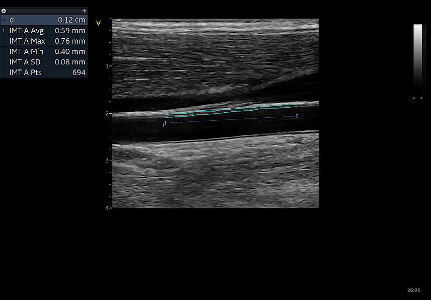 Clinical image captured using Auto IMT