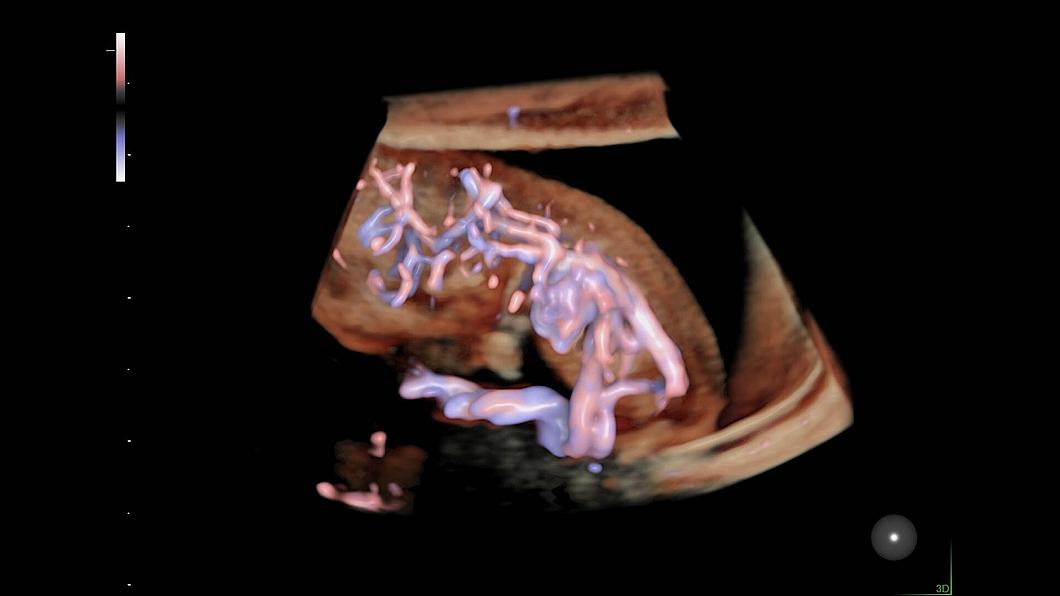 Obraz ultrasonograficzny układu krążenia 9-tygodniowego płodu