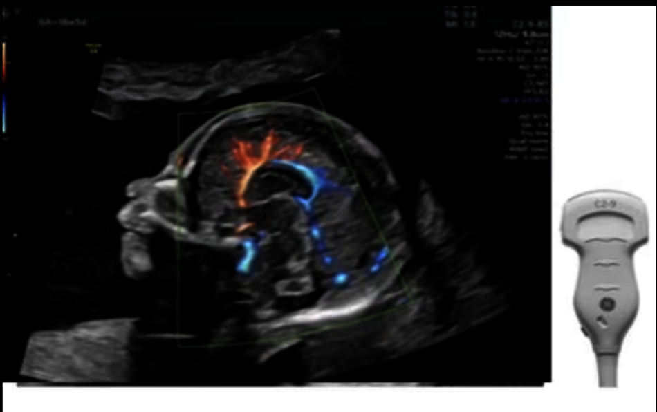 Imagine ecografică a unui fetus obținută cu sonda C2-9