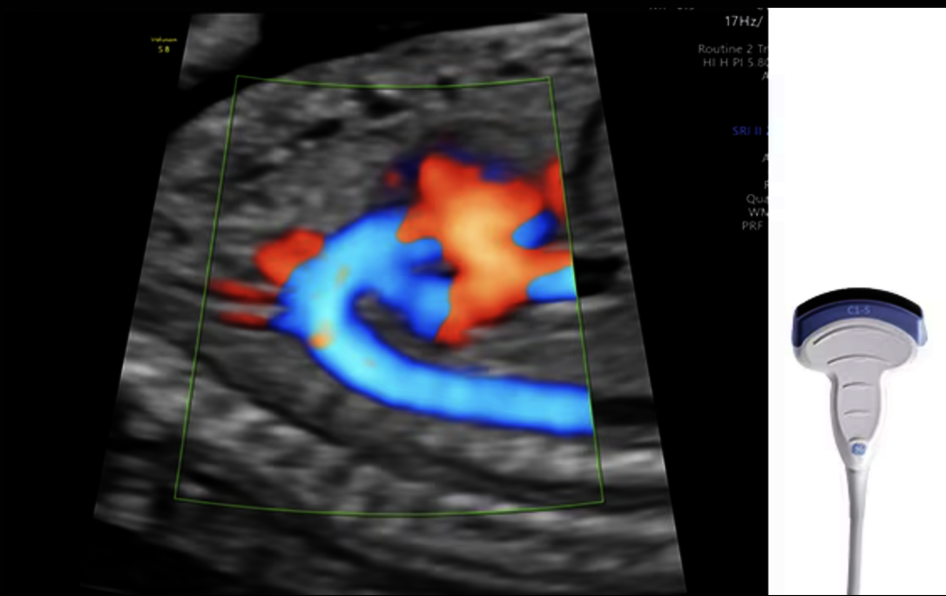 Obraz ultrasonograficzny zarejestrowany przy użyciu sondy C1-5-RS