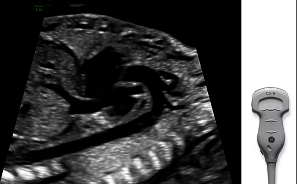 XDclear vizsgálófejjel rögzített ultrahangkép.