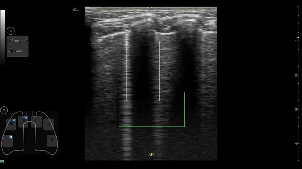Ultrasound image captured the Auto B-lines tool