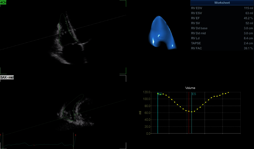 Ultrasound image captured using 4D AUTO RVQ