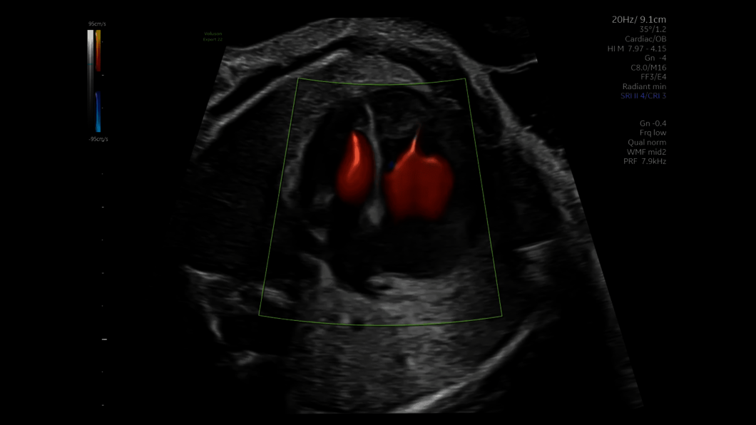 Obraz USG serca płodu uchwycony z wykorzystaniem funkcji Radiantflow