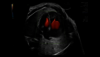 Obraz USG serca płodu uchwycony z wykorzystaniem funkcji Radiantflow