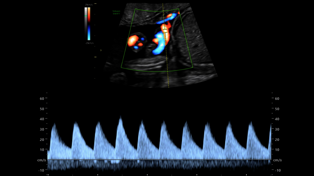 Obraz USG: Doppler tętnicy pępowinowej