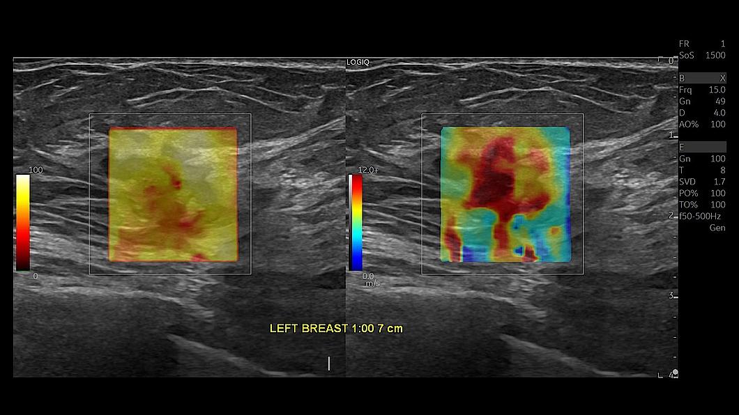 Leziune mamară identificată cu 2D Shear Wave Elastography, ML4-20-D