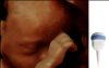 Imagine ecografică a unui fetus obținută cu sonda RAB6-RS