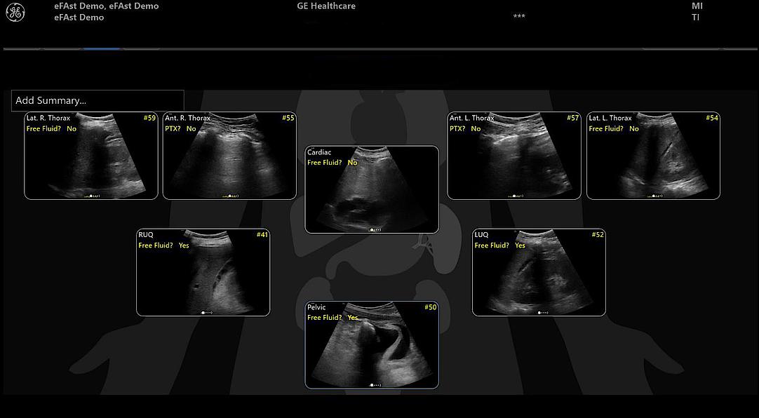 Obraz ultrasonograficzny z przeglądu wykresu eFAST z dodatnimi wynikami.