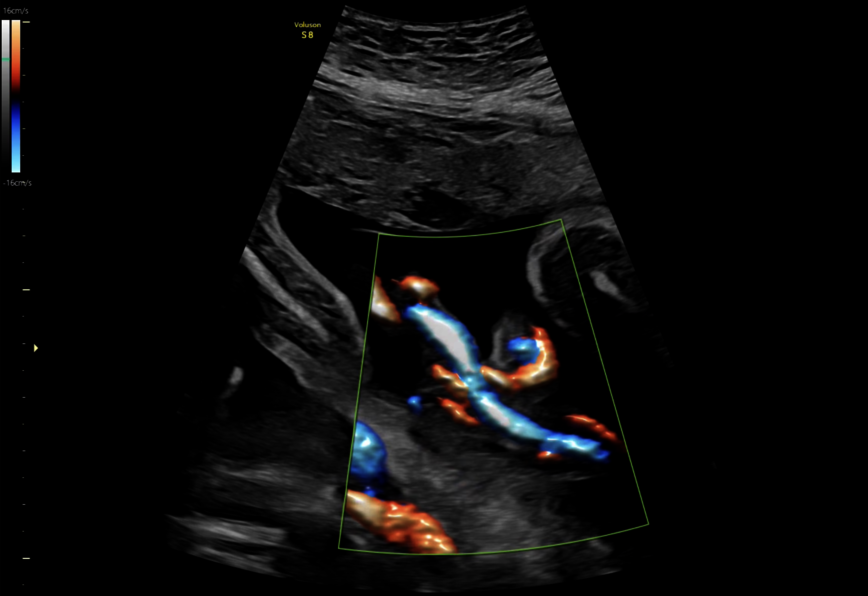 Obraz ultrasonograficzny uzyskany za pomocą Radiantflow