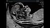 Υπερηχογραφική εικόνα εμβρύου