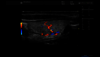 Ultrazvukový snímek: Thyroidea v barvě, dlouhá osa