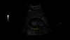 A vese, az epehólyag hasüregen belüli letapogatásával készített ultrahangfelvétel