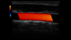 Przepływ w tętnicy szyjnej wspólnej w kolorze, L6-12-RS