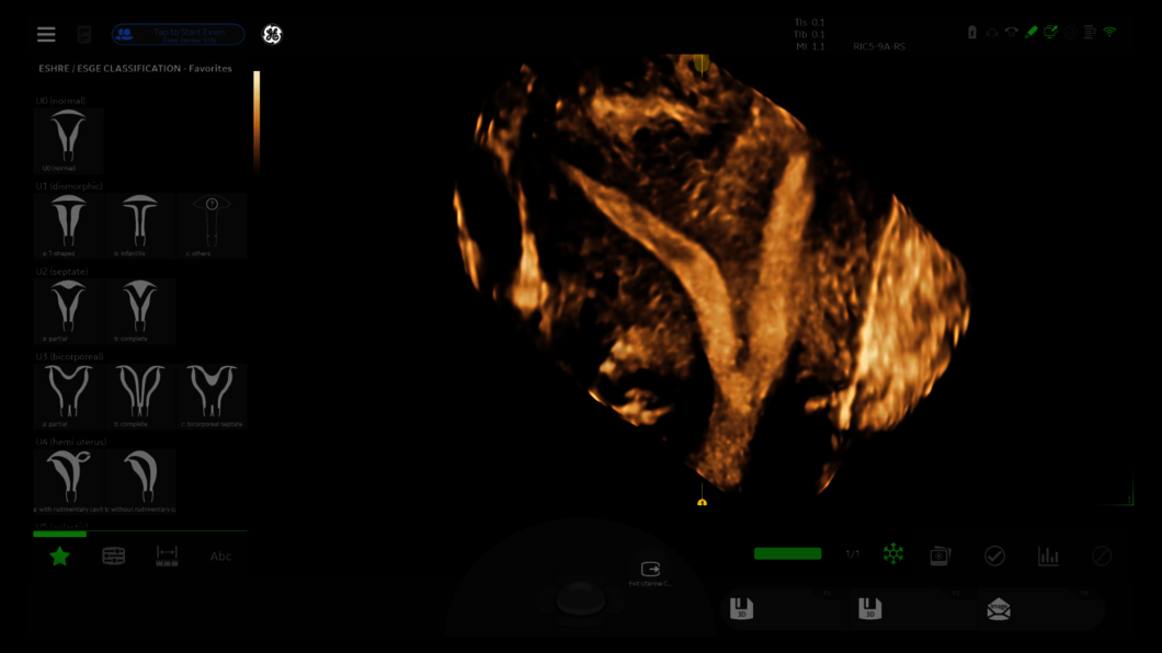 Ultrahangfelvétel: Méhnyálkahártya ESHRE | ESGE a méh osztályozásaival