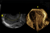 Obraz ultrasonograficzny 3D kobiecej macicy