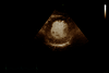 LVO Contrast: High-resolution contrast display of the LV cavity