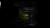 Ultrazvukový snímek zachycený pomocí funkce cNerve