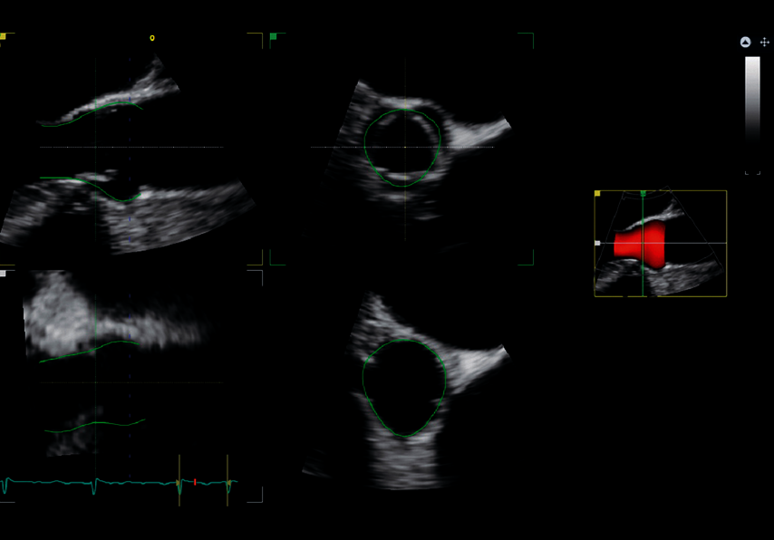A 4D Auto MVQ használatával rögzített klinikai kép
