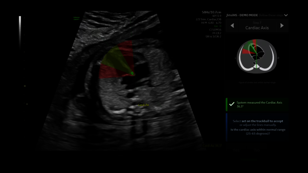 Obraz USG uchwycony z wykorzystaniem funkcji fetalHS