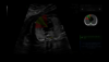 Magzati HS-sel rögzített ultrahangfelvétel
