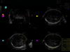Imagine ecografică a creierului fetal capturată cu SonoCNS