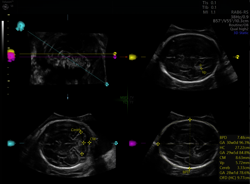 Imagine ecografică a creierului fetal capturată cu SonoCNS