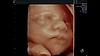 Imagine ecografică a unei fețe fetale capturată folosind HDlive