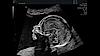Obraz ultrasonograficzny profilu płodu