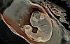 Ecografie ce prezintă un fetus, capturată cu HDlive Silhouette