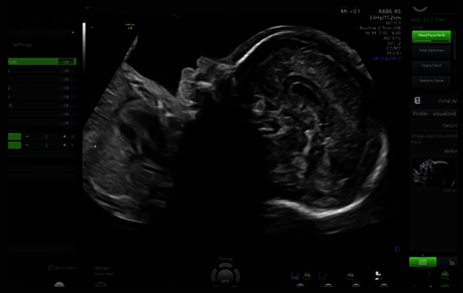 Obraz ultrasonograficzny zarejestrowany przy użyciu Scan Assistant