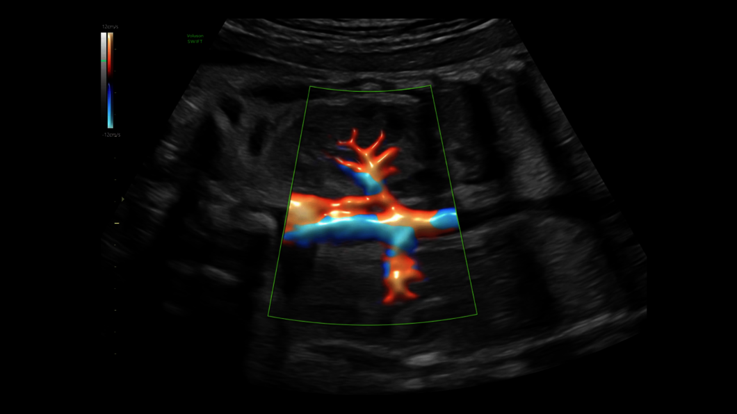 Obraz USG aorty i nerek uchwycony z wykorzystaniem funkcji Radiantflow