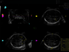 Obraz USG mózgu płodu uchwycony z wykorzystaniem aplikacji SonoCNS