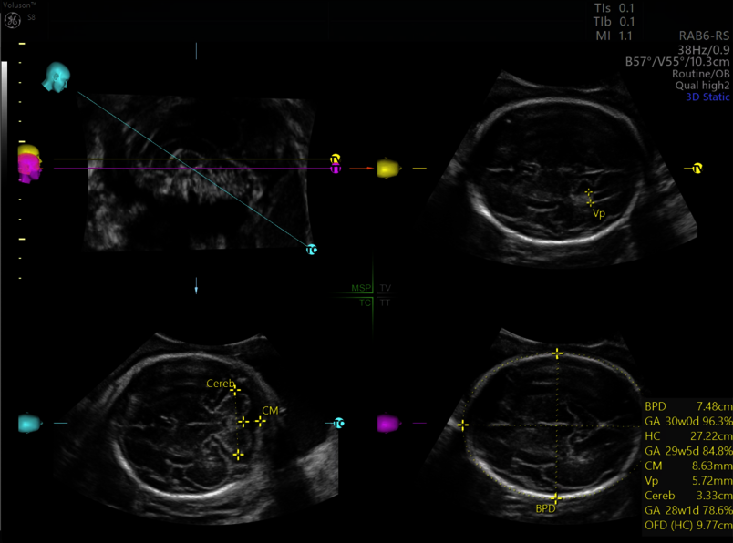 Obraz USG mózgu płodu uchwycony z wykorzystaniem aplikacji SonoCNS