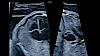 Ultrazvukový snímek zachycený pomocí biplanárního zobrazení e4D