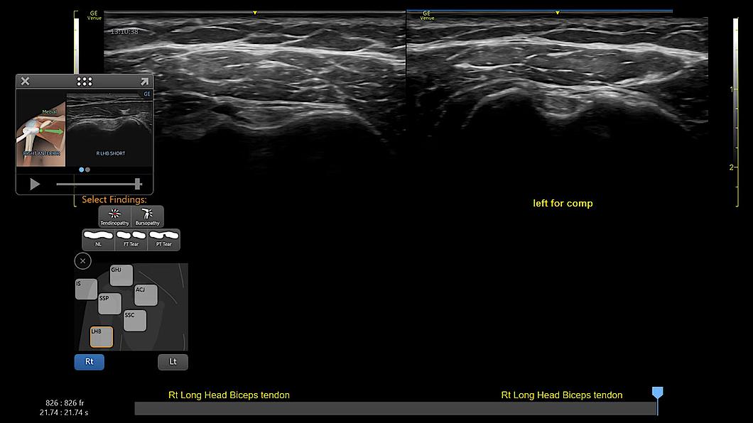 A Shoulder Diagram használatával rögzített ultrahangkép