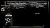 Ultrazvukový snímek zachycený pomocí diagramu ramene
