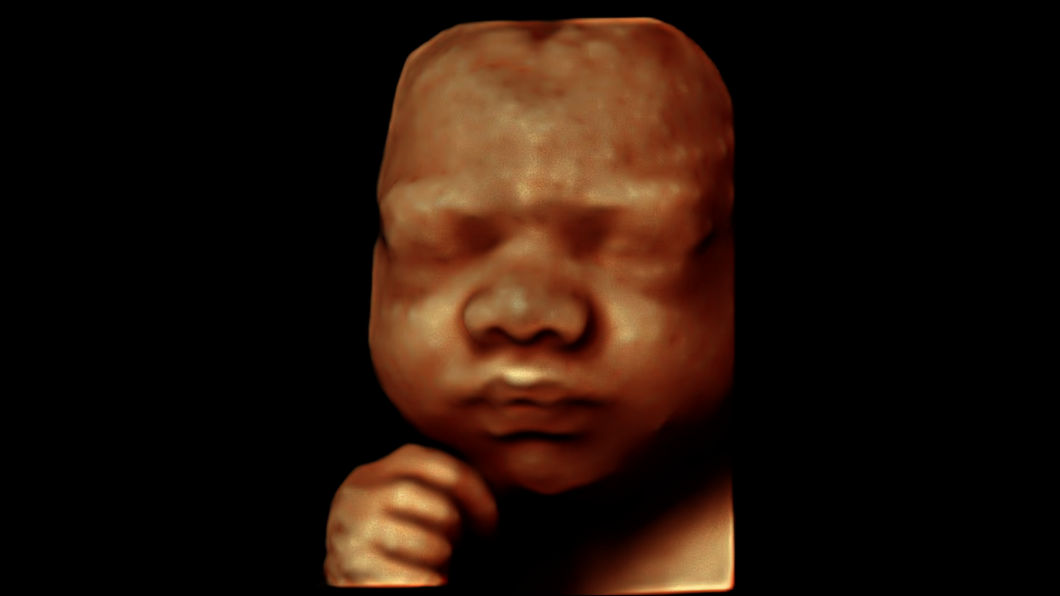 Obraz USG twarzy 28-tygodniowego płodu uchwycony z wykorzystaniem funkcji HDlive