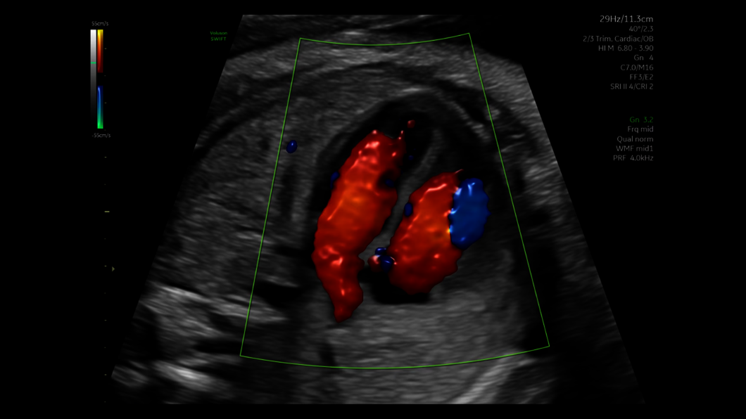 26 hetes magzat szívének ultrahangfelvétele Radiantflow-val rögzítve