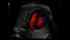 Obraz USG serca 26-tygodniowego płodu uchwycony z wykorzystaniem funkcji Radiantflow