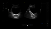 Ultrasound image: Dual screen bladder
