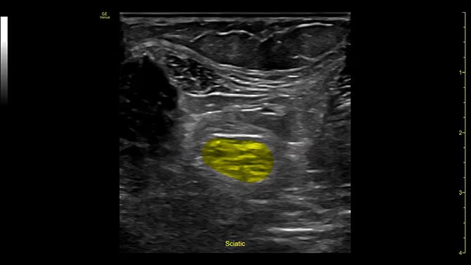 Ultrasound image captured using cNerve.