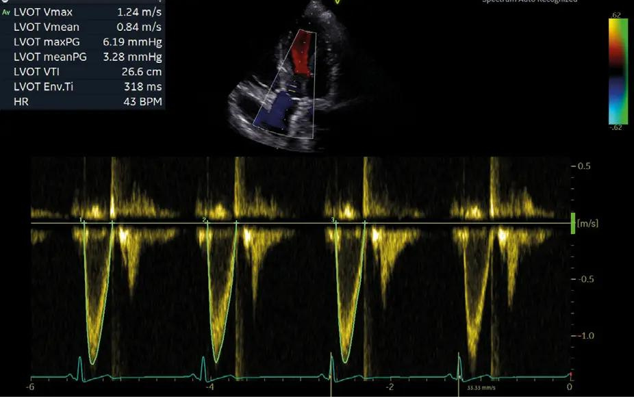 Imagine clinică obținută cu AI Cardiac Auto Doppler
