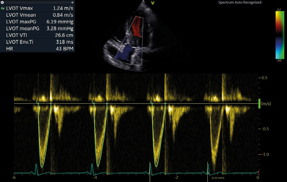 Obraz kliniczny zarejestrowany za pomocą AI Cardiac Auto Doppler