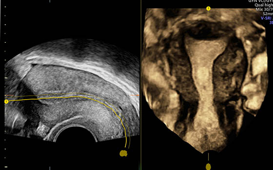 3D ultrasound image of the female uterus