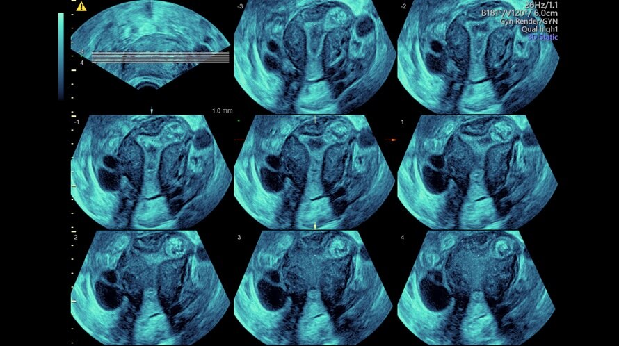 Obraz USG jamy macicy uchwycony z wykorzystaniem technologii Tomographic Ultraosound Imaging (TUI)